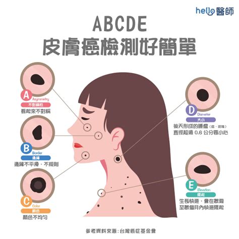 臉 長痣|皮膚長痣、長斑是皮膚癌前兆？皮膚癌初期4大症狀快。